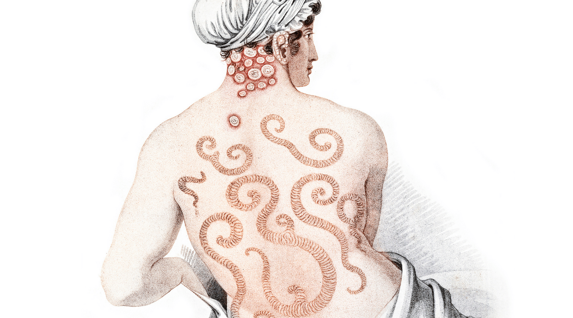 Illustration of woman with clothing pulled down to reveal red and brown swirls on her back
