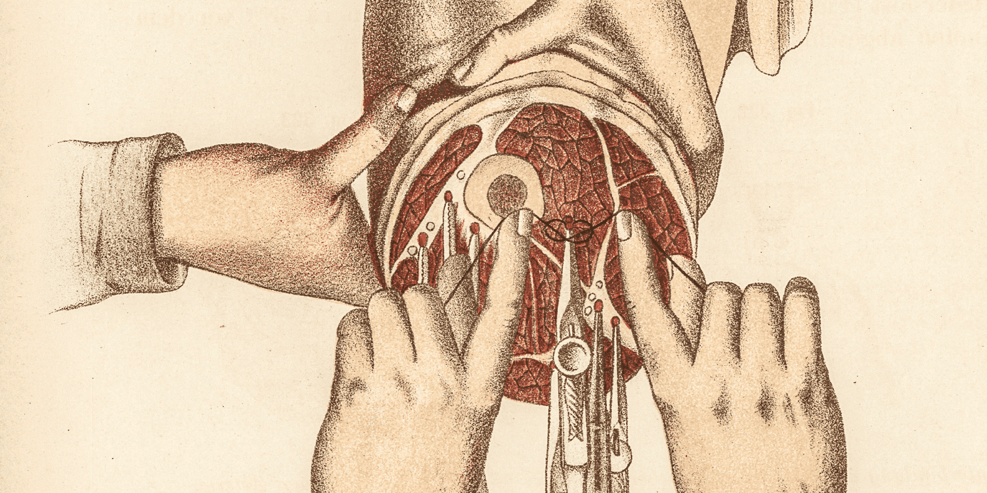 Illustration of four hands holding medical tools and cutting away at a cross-section of an amputated limb