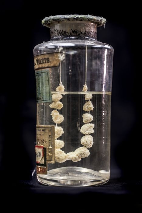 A clear glass jar containing a set of genital warts connected together by string