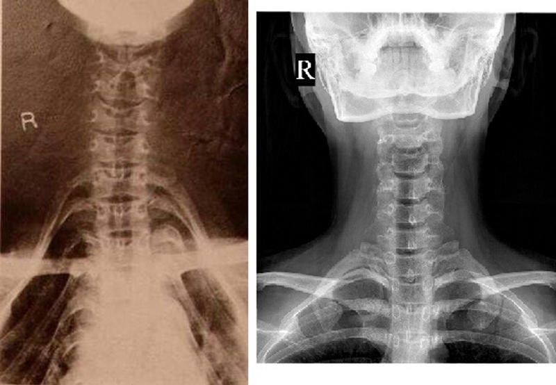 Two side-by-side X-ray images. The x-ray on the left represents an extended neck. The collarbone has been pressed down away from the neck bones, giving the illusion of an elongated neck. The x-ray image on the right shows the &quot;normal&quot; skeletal structure of the neck with no extensions.