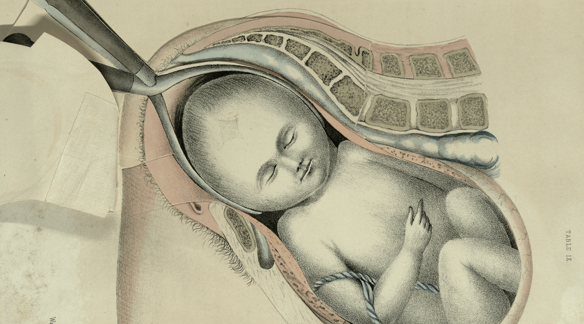 Anatomical illustration of a baby being pulled from its mother with forceps
