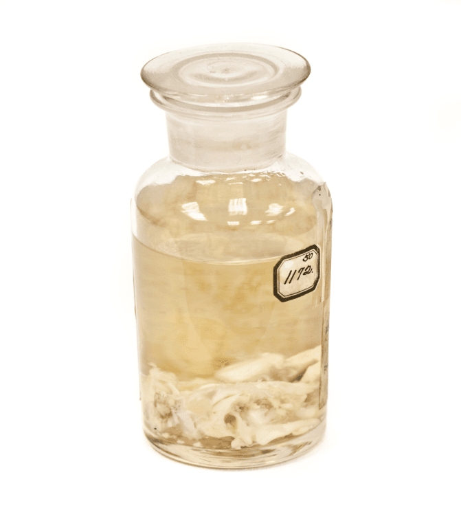 A jar containing parts of a tumor removed from US President Grover Cleveland