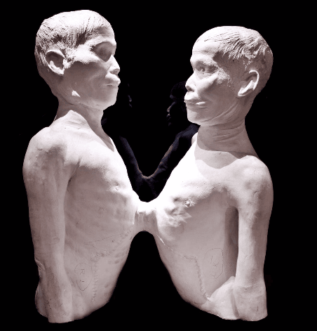 Death cast of Chang and Eng Bunker,The Mütter Museum