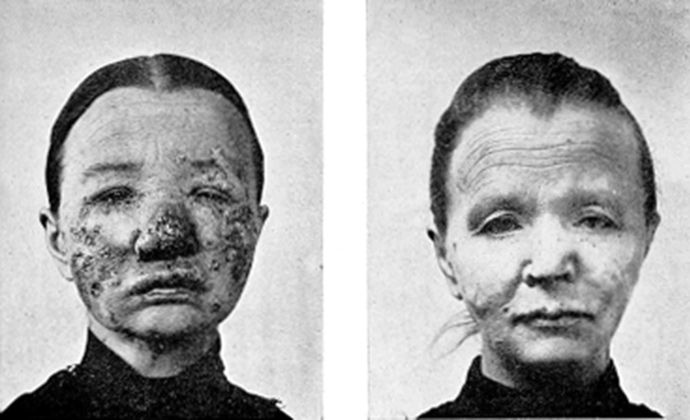 Before and after photos of a patient treated for lupus vulgaris with light therapy