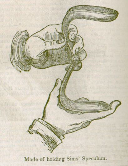 Illustration of two hands holding a vaginal speculum. A caption reads, &quot;Mode of holding Sims' speculum.&quot; 