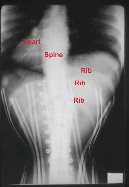 X-ray image of a human midsection constricted by a corset. The x-ray labels the heart, spine, and three ribs bent out of shape by the corset.