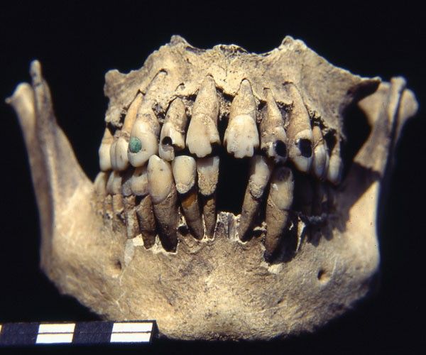 Sections of the upper and lower jaw of a human skull. Carved stone inlays appear in several teeth in the upper jaw.