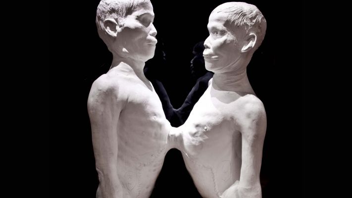 Death cast of twins Chang and Eng Bunker conjoined at the torso