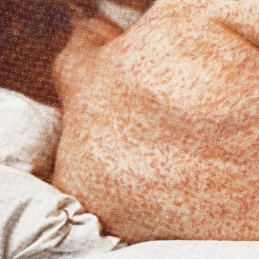 The back of a woman's neck and back exposed to show a pattern of red splotches on the skin