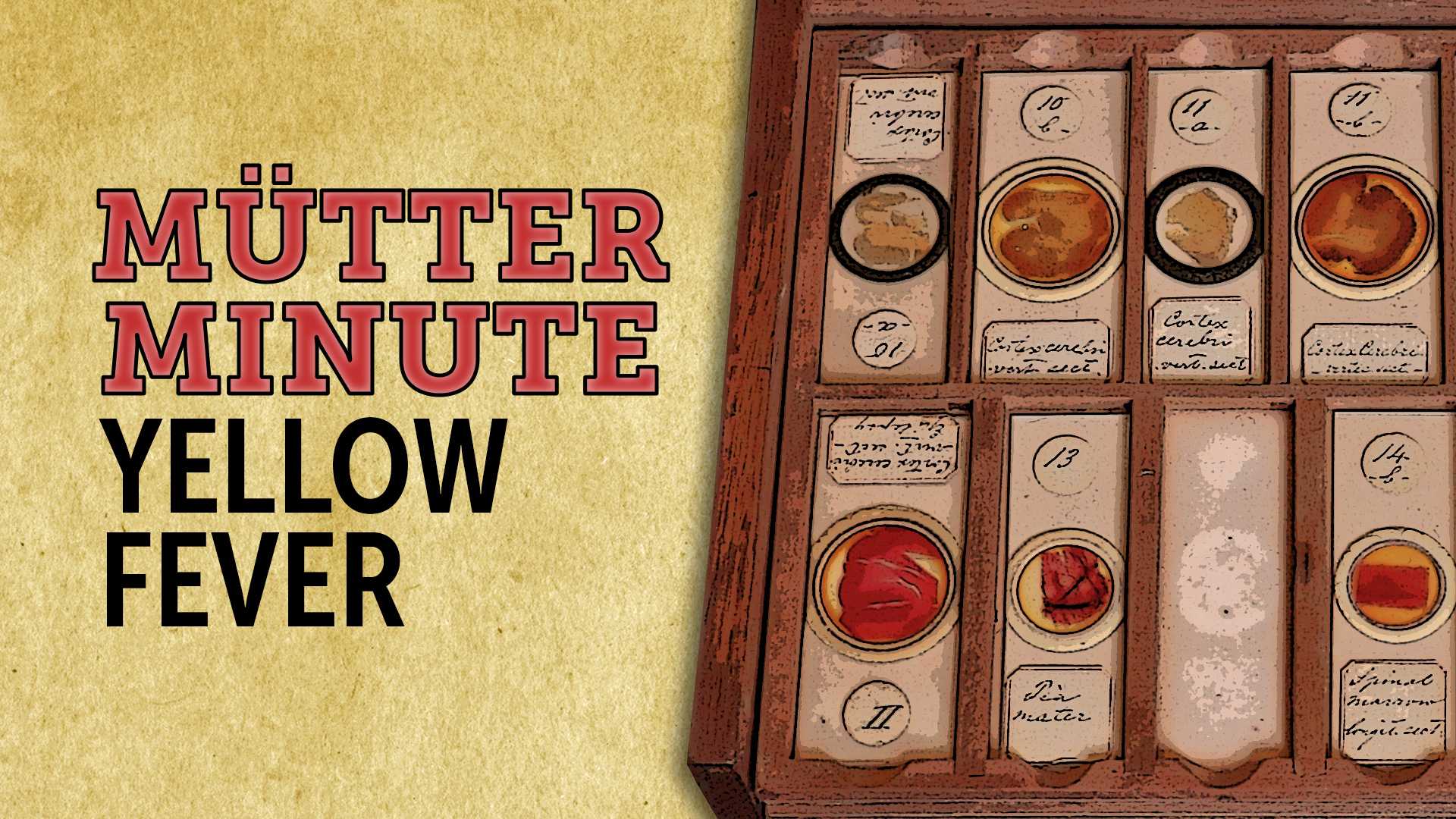 Old medical slides with yellow fever samples next to text that reads "Mütter Minute: Yellow Fever"