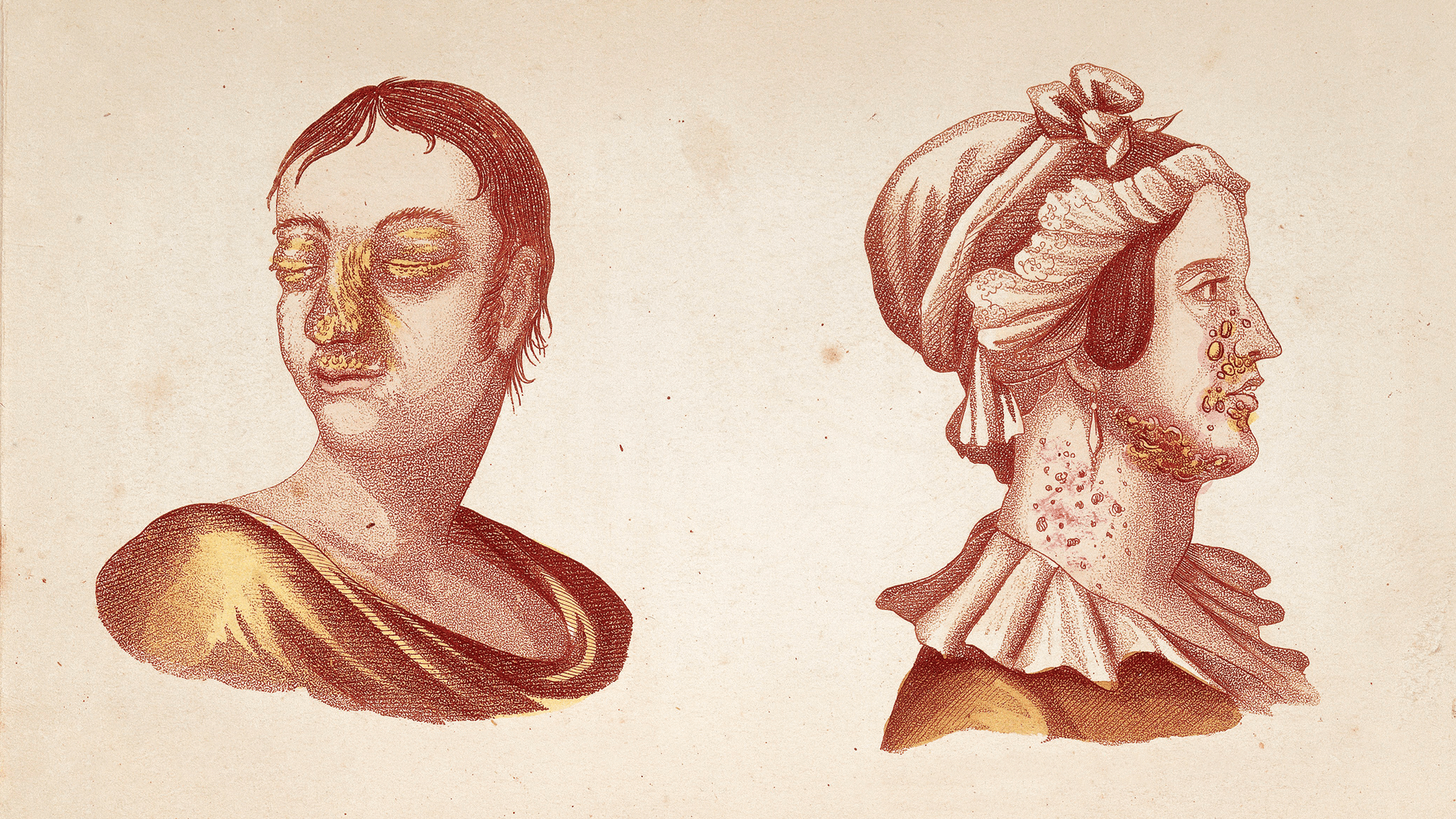 Two red and orange illustrations of figures with skin damage