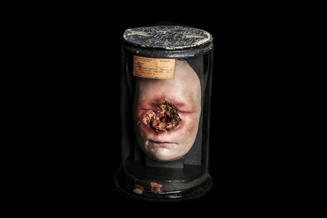 Wax model of a syphilitic face