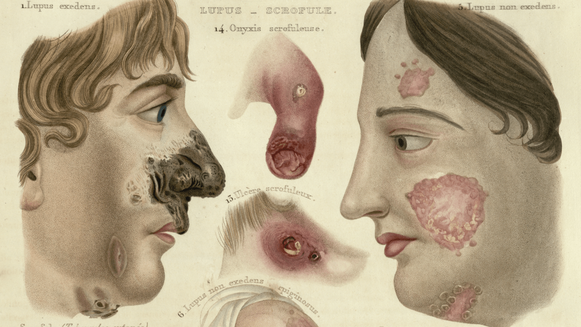 Colorful illustrations of skin damage of various severity 