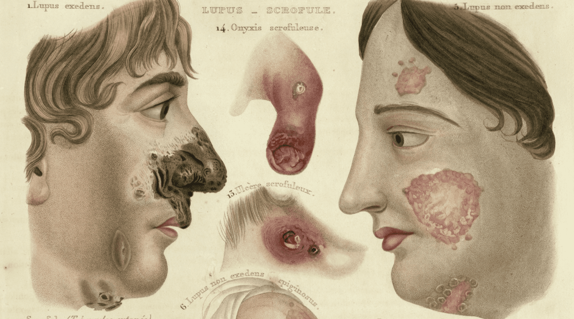 Colorful illustrations of skin damage of various severity 